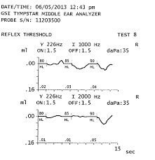 Acoustic Reflex Testing